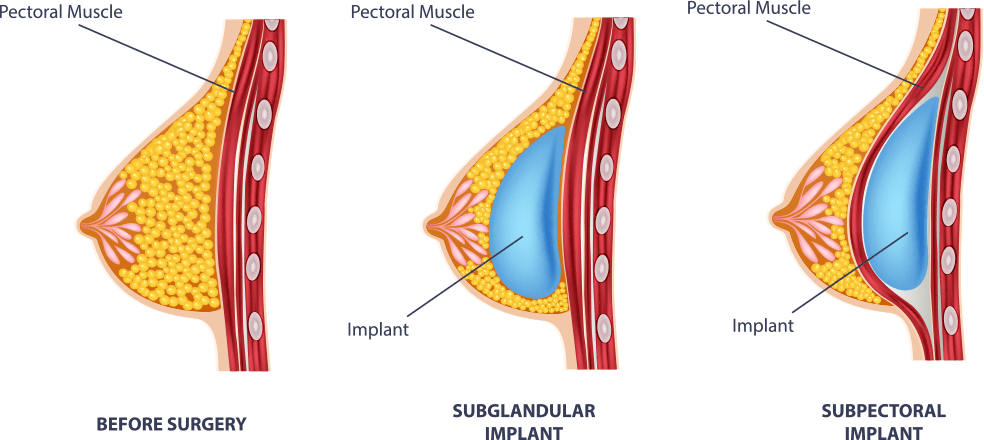 Breast Augmentation Surgery in Orlando Florida FL