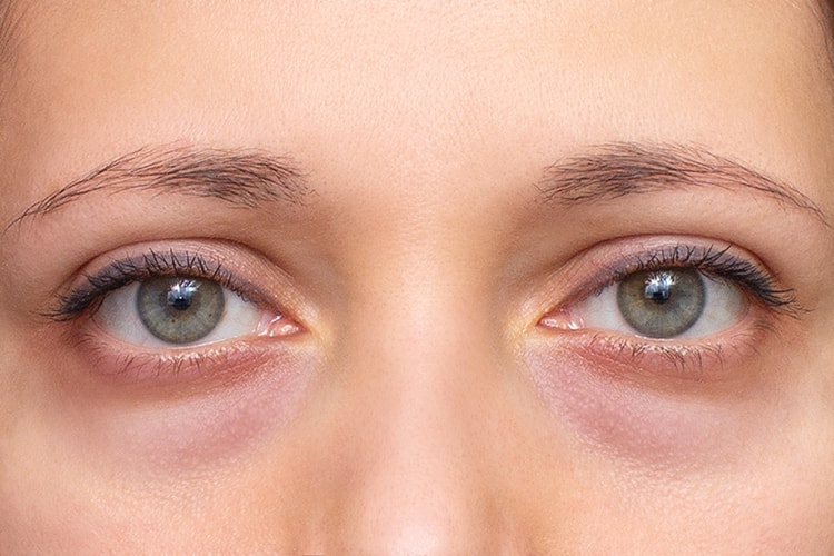 heavy eyelids